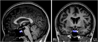 Pituitary Volume and Socio-Cognitive Functions in Individuals at Risk of Psychosis and Patients With Schizophrenia